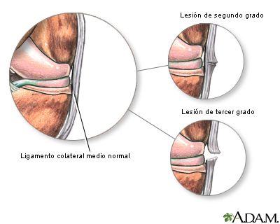 Lesión del ligamento medial colateral