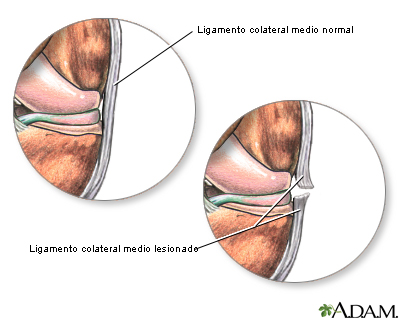 Ligamento medial colateral desgarrado