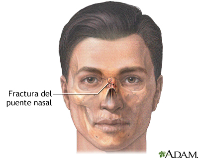 Fractura nasal