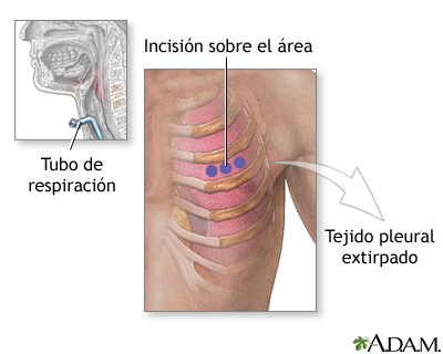 Incisión para biopsia de tejido pleural