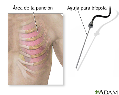 Biopsia pleural