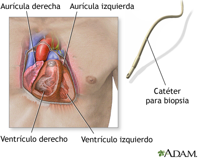 Catéter para biopsia