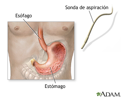 Examen de ácido estomacal