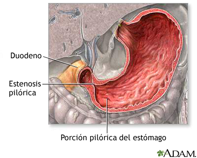 Estenosis pilórica