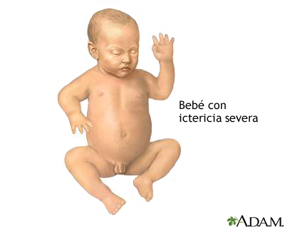 Ictericia infantil