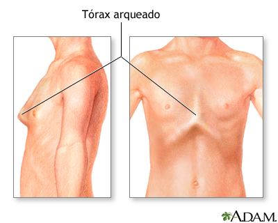 Tórax arqueado (pecho de paloma)