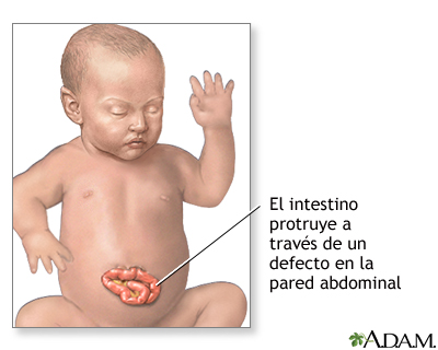 Hernia abdominal infantil (gastrosquisis)