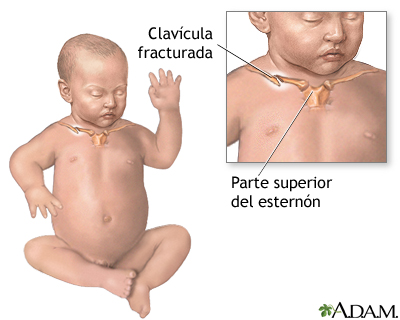 Clavícula fracturada en un recién nacido