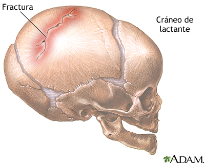 Fractura de cráneo en lactante