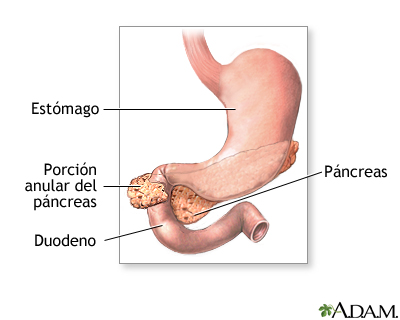 Páncreas anular