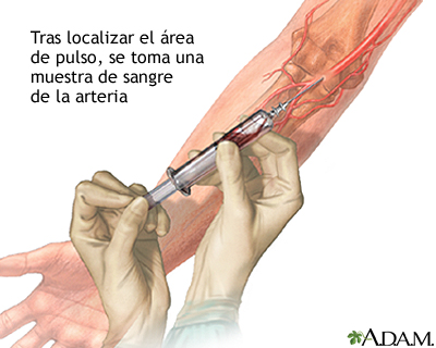 Muestra de sangre arterial