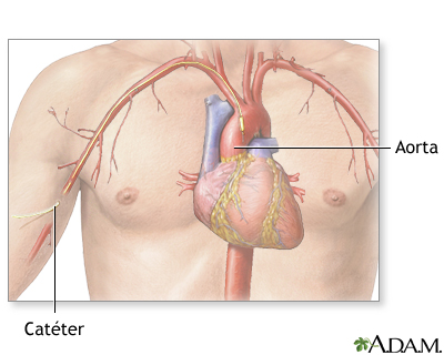 Arteriograma cardíaco