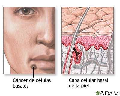 Cáncer de células basales