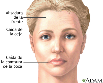 Caída facial