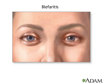 Blefaritis