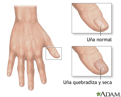 Uñas quebradizas