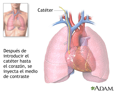 Cateterización cardíaca