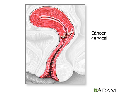 Cáncer cervical