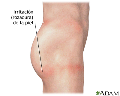 Irritación de la piel