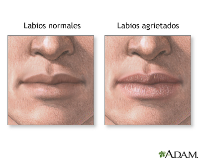 Labios agrietados