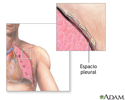 Espacio pleural