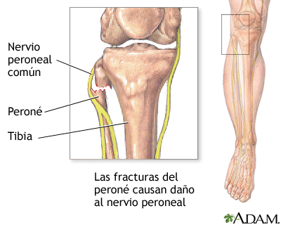 Disfunción del nervio peroneo común