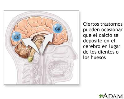 Calcificación craneal