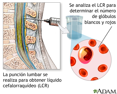 Conteo de células del LCR