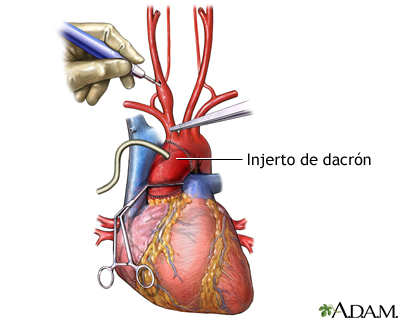 Colocación de injerto de dacrón