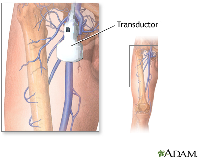 Ultrasonografía Doppler de una extremidad