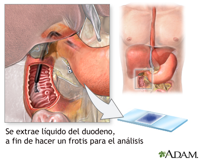 Frotis del tejido duodenal