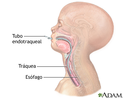 Intubación endotraqueal