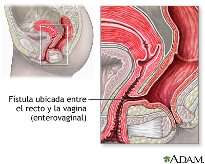 Fístula