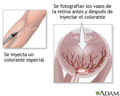 Inyección de colorante en la retina