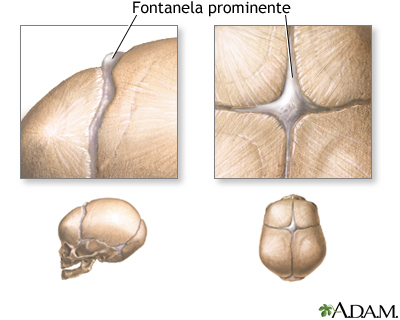 Fontanelas abultadas