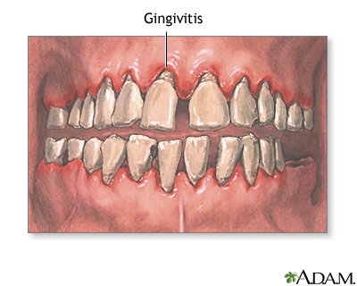 Gingivitis