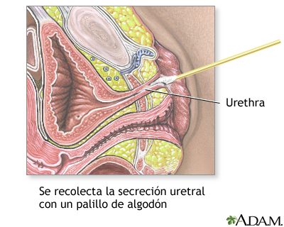 Tinción de gram de la secreción uretral