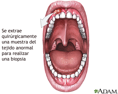 Biopsia de las encías