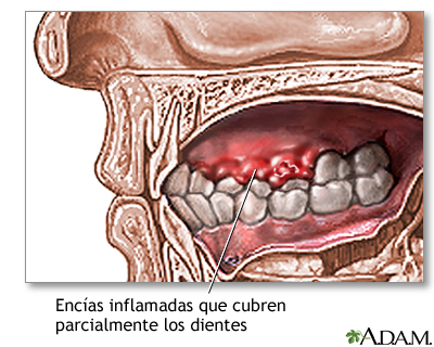 Encías inflamadas