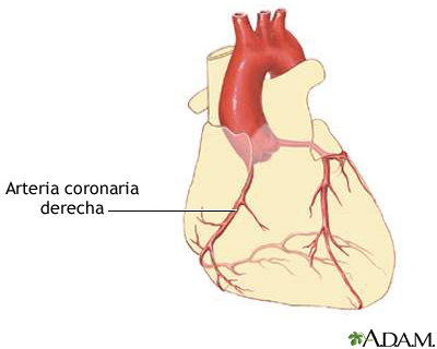 Enfermedad de las arterias coronarias