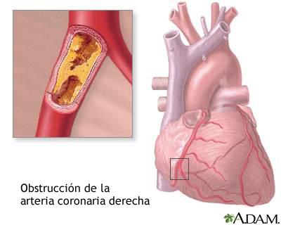 Obstrucción de las arterias coronarias