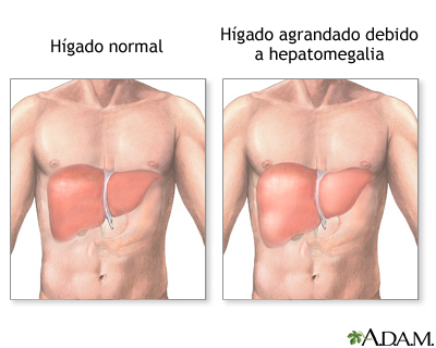 Hepatomegalia