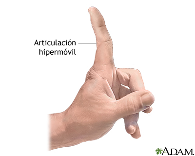 Articulaciones hipermóviles