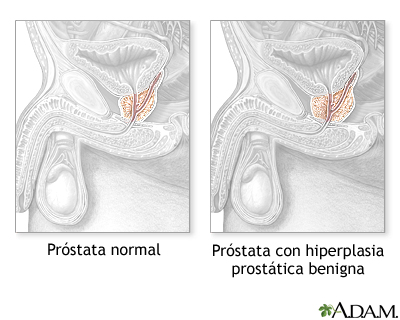 Hiperplasia