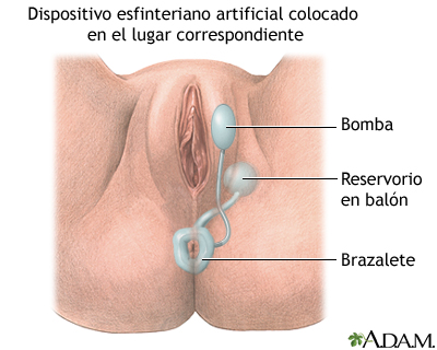 Esfínter artificial inflable