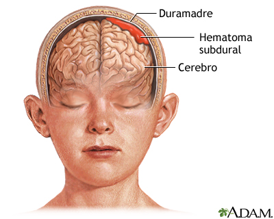 Hematoma subdural