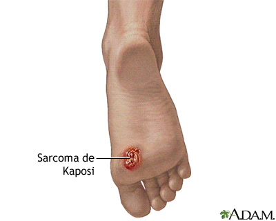 Sarcoma de Kaposi