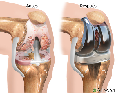 Prótesis de reemplazo de la articulación de la rodilla