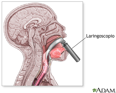 Laringoscopio