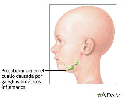 Protuberancia en el cuello